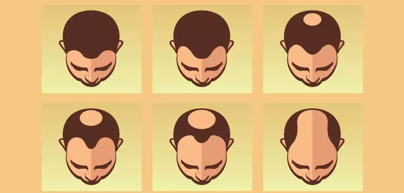 Why Men Are Going Bald Younger - and 8 Ways to Stop the Shedding